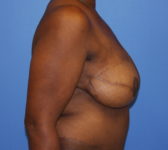 Patient 602 - Surgery 4 Photo 5 - Mastopexy Breast Reduction DIEP Flap Surgery - Breast Cancer Texas