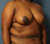 Patient 392 Before Surgey Photo 4 - DIEP Flap Surgery - Breast Cancer Texas