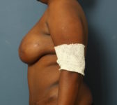 Patient 392 - Surgery 1 Photo 1 - DIEP Flap Surgery - Breast Cancer Texas