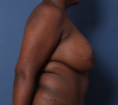 Patient 392 - Surgery 2 Photo 5 - DIEP Flap Surgery - Breast Cancer Texas
