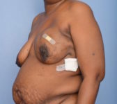 Patient 380 Before Surgey Photo 2 - DIEP Flap Surgery - Breast Cancer Texas