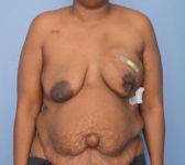 Patient 380 Before Surgey Photo 3 - DIEP Flap Surgery - Breast Cancer Texas