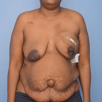 Patient 380 Before Overview - DIEP Flap Surgery - Breast Cancer Texas