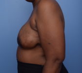 Patient 380 - Surgery 1 - DIEP flap Photo 1 - DIEP Flap Surgery - Breast Cancer Texas