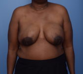 Patient 380 - Surgery 1 - DIEP flap Photo 3 - DIEP Flap Surgery - Breast Cancer Texas