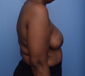 Patient 380 - Surgery 1 - DIEP flap Photo 5 - DIEP Flap Surgery - Breast Cancer Texas