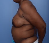 Patient 380 - Surgery 2 Photo 1 - DIEP Flap Surgery - Breast Cancer Texas