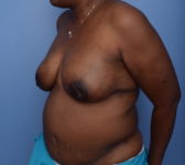 Patient 380 - Surgery 2 Photo 2 - DIEP Flap Surgery - Breast Cancer Texas