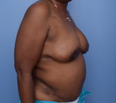 Patient 380 - Surgery 2 Photo 4 - DIEP Flap Surgery - Breast Cancer Texas