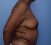 Patient 380 - Surgery 2 Photo 5 - DIEP Flap Surgery - Breast Cancer Texas