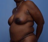 Patient 380 - Surgery 3 Photo 2 - DIEP Flap Surgery - Breast Cancer Texas