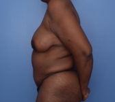 Patient 380 - Nipple Reconstruction Photo 1 - DIEP Flap Surgery - Breast Cancer Texas