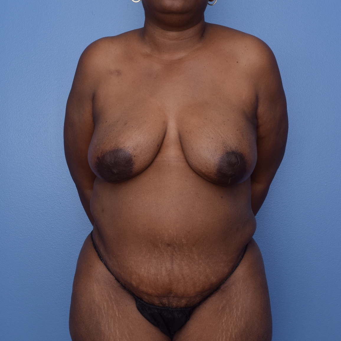 Patient 380 After Overview - Sidebar - DIEP Flap Surgery - Breast Cancer Texas