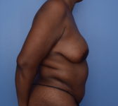 Patient 380 - Nipple Reconstruction Photo 5 - DIEP Flap Surgery - Breast Cancer Texas