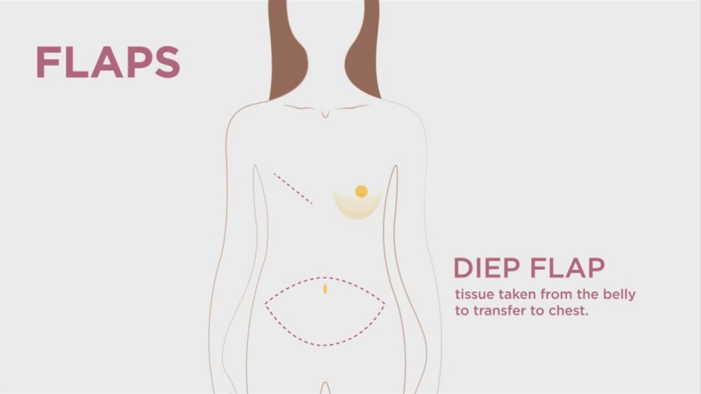 DIEP Flap Breast Reconstruction - Breast Cancer Texas