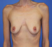 Patient 510 Before Surgey Photo 3 - Tissue Expander Implant - Breast Cancer Texas