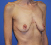 Patient 510 Before Surgey Photo 4 - Tissue Expander Implant - Breast Cancer Texas