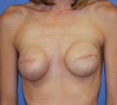 Patient 510 - Surgery 1 Photo 3 - Tissue Expander Implant - Breast Cancer Texas