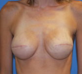 Patient 510 - Surgery 2 Photo 3 - Tissue Expander Implant - Breast Cancer Texas