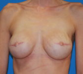 Patient 510 - Surgery 3 Photo 3 - Tissue Expander Implant - Breast Cancer Texas