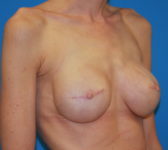 Patient 510 - Surgery 3 Photo 4 - Tissue Expander Implant - Breast Cancer Texas