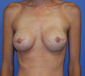 Patient 510 - Surgery 4 Photo 3 - Tissue Expander Implant - Breast Cancer Texas