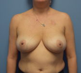 Patient 721 Before Surgey Photo 3 - Nipple Sparing Mastectomy Tissue Expander Implant - Breast Cancer Texas