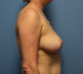 Patient 721 Before Surgey Photo 5 - Nipple Sparing Mastectomy Tissue Expander Implant - Breast Cancer Texas