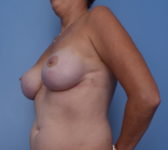 Patient 721 - Surgery 2 Photo 2 - Nipple Sparing Mastectomy Tissue Expander Implant - Breast Cancer Texas