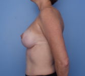 Patient 721 - 1 year postop Photo 1 - Nipple Sparing Mastectomy Tissue Expander Implant - Breast Cancer Texas