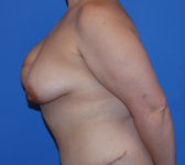 Patient 435 - Surgery 2 Photo 1 - Breast Augmentation Mastopexy Tissue Expander Implant DIEP Flap Surgery - Breast Cancer Texas