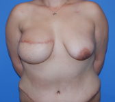 Patient 435 - Surgery 2 Photo 3 - Breast Augmentation Mastopexy Tissue Expander Implant DIEP Flap Surgery - Breast Cancer Texas