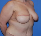 Patient 435 - Surgery 2 Photo 4 - Breast Augmentation Mastopexy Tissue Expander Implant DIEP Flap Surgery - Breast Cancer Texas