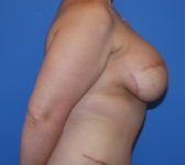 Patient 435 - Surgery 2 Photo 5 - Breast Augmentation Mastopexy Tissue Expander Implant DIEP Flap Surgery - Breast Cancer Texas