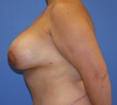 Patient 435 - Surgery 3 Photo 1 - Breast Augmentation Mastopexy Tissue Expander Implant DIEP Flap Surgery - Breast Cancer Texas