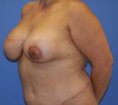 Patient 435 - Surgery 3 Photo 2 - Breast Augmentation Mastopexy Tissue Expander Implant DIEP Flap Surgery - Breast Cancer Texas