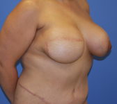Patient 435 - Surgery 3 Photo 4 - Breast Augmentation Mastopexy Tissue Expander Implant DIEP Flap Surgery - Breast Cancer Texas