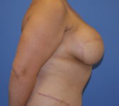 Patient 435 - Surgery 3 Photo 5 - Breast Augmentation Mastopexy Tissue Expander Implant DIEP Flap Surgery - Breast Cancer Texas