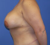 Patient 435 - Surgery 4 Photo 1 - Breast Augmentation Mastopexy Tissue Expander Implant DIEP Flap Surgery - Breast Cancer Texas