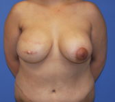 Patient 435 - Surgery 4 Photo 3 - Breast Augmentation Mastopexy Tissue Expander Implant DIEP Flap Surgery - Breast Cancer Texas