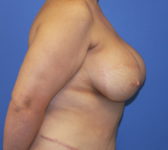 Patient 435 - Surgery 4 Photo 5 - Breast Augmentation Mastopexy Tissue Expander Implant DIEP Flap Surgery - Breast Cancer Texas