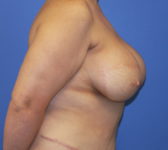 Patient 435 - Surgery 4 Photo 5 - Breast Augmentation Mastopexy Tissue Expander Implant DIEP Flap Surgery - Breast Cancer Texas