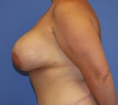 Patient 435 - Surgery 5 Photo 1 - Breast Augmentation Mastopexy Tissue Expander Implant DIEP Flap Surgery - Breast Cancer Texas