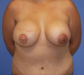 Patient 435 - Surgery 5 Photo 3 - Breast Augmentation Mastopexy Tissue Expander Implant DIEP Flap Surgery - Breast Cancer Texas