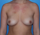 Patient 175 Before Surgey Photo 3 - Tissue Expander Implant - Breast Cancer Texas