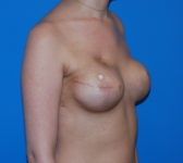 Patient 175 - Surgery 1 Photo 4 - Tissue Expander Implant - Breast Cancer Texas