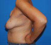 Patient 622 - Surgery 1 Photo 1 - Breast Augmentation Mastopexy Tissue Expander Implant DIEP Flap Surgery - Breast Cancer Texas