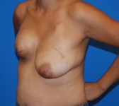 Patient 622 - Surgery 1 Photo 2 - Breast Augmentation Mastopexy Tissue Expander Implant DIEP Flap Surgery - Breast Cancer Texas