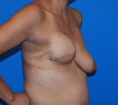 Patient 622 - Surgery 1 Photo 4 - Breast Augmentation Mastopexy Tissue Expander Implant DIEP Flap Surgery - Breast Cancer Texas