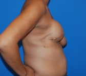 Patient 622 - Surgery 1 Photo 5 - Breast Augmentation Mastopexy Tissue Expander Implant DIEP Flap Surgery - Breast Cancer Texas